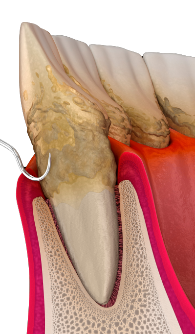 Scaling And Root Planning Parkway Periodontics